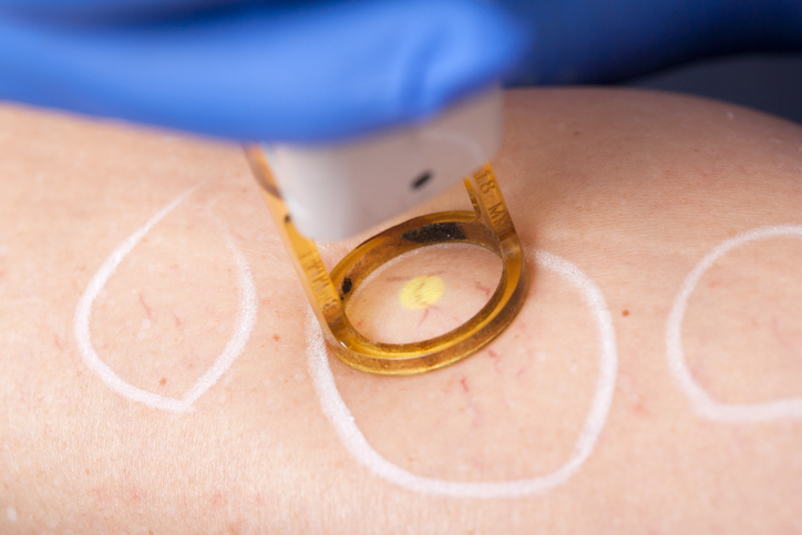 Why there isn’t one laser for all treatments