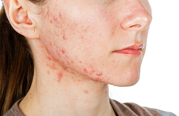 Adult Acne: The tales, the truth, the treatment