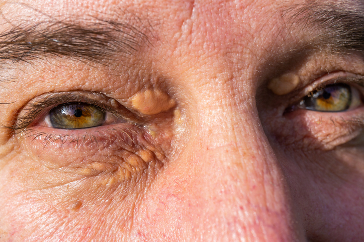 What is xanthelasma, and how can you treat it?