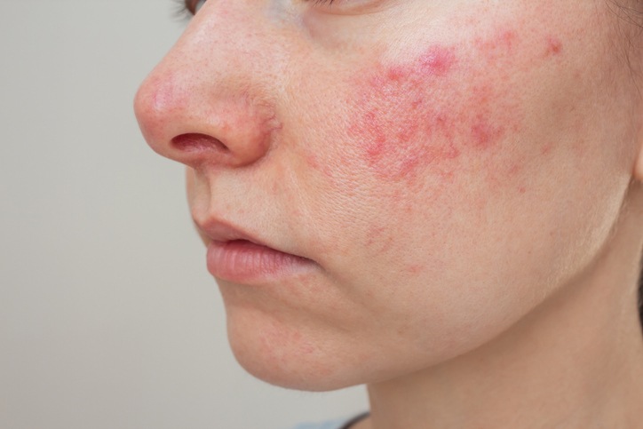 What is the difference between eczema, dermatitis and psoriasis?