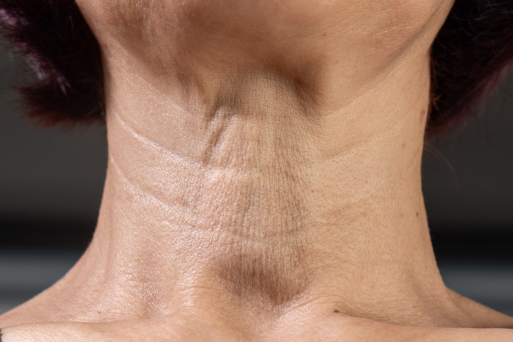 How do you treat platysmal bands?
