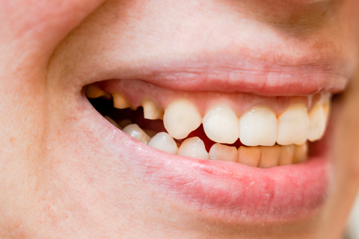 3 Ways to Fix a Gummy Smile Without Surgery