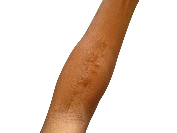 Hypertrophic scars: what are they, and will they ever go away?