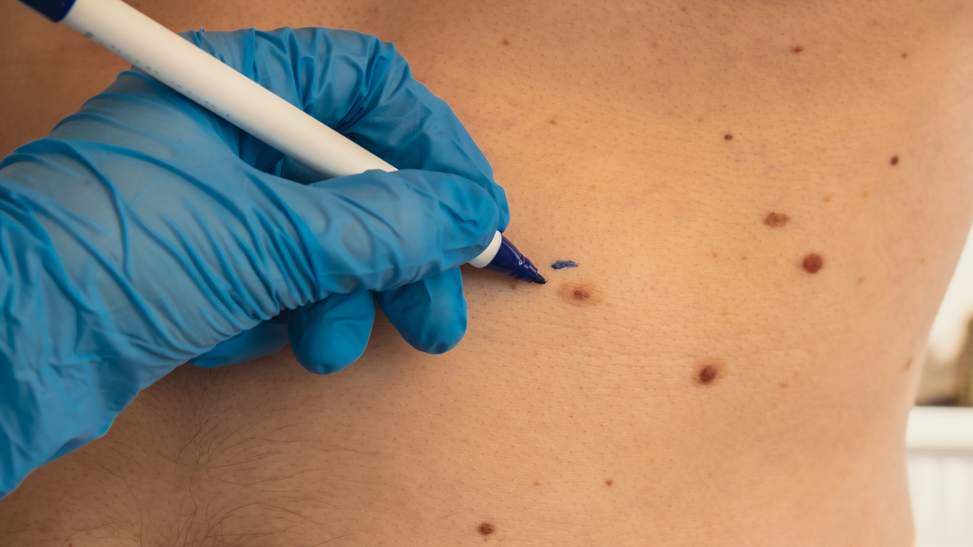 Birthmark Removal: Should You or Shouldn’t You?