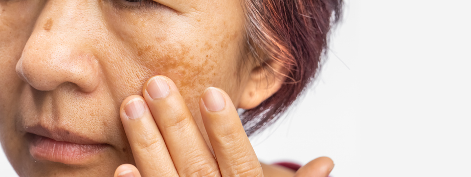 Understanding and Treating Melasma